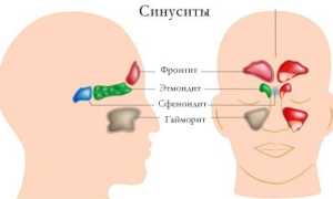 Экссудативный синусит