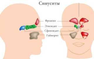 Экссудативный синусит