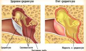 Отит при беременности