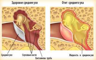 Отит при беременности
