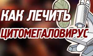 Как лечить цитомегаловирус?