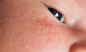 Стоит ли волноваться из за прыщиков на лице грудничка