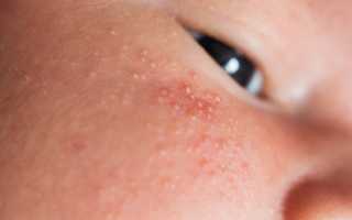 Стоит ли волноваться из за прыщиков на лице грудничка