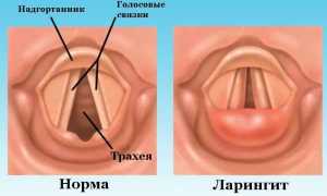 Что такое фаринголарингит (ларингофарингит) и как он проявляется у детей и взрослых?