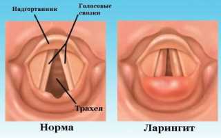 Что такое фаринголарингит (ларингофарингит) и как он проявляется у детей и взрослых?
