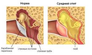 Острый гнойный отит