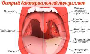 Питание при ангине у детей и взрослых