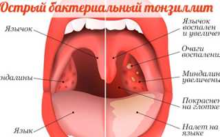 Питание при ангине у детей и взрослых