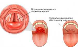 Гиперпластический (гипертрофический) ларингит