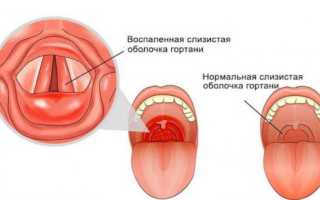 Гиперпластический (гипертрофический) ларингит