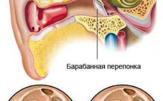 Тимпанопластика — операция на среднем ухе: показания, виды, проведение, результат и реабилитация