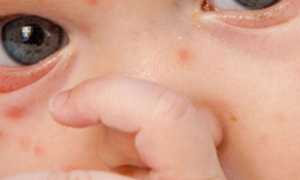 Как лечится ветрянка у грудничков и какие есть методы профилактики, чтобы малыш не заболел