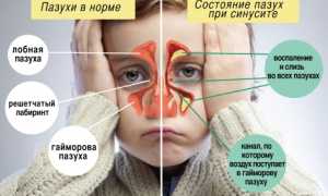 Как диагностировать и лечить гайморит у ребенка 3 лет?