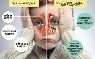 Как диагностировать и лечить гайморит у ребенка 3 лет?