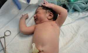 Омфалит у новорожденных: симптомы, лечение, отзывы с форума