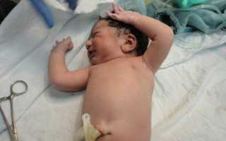 Омфалит у новорожденных: симптомы, лечение, отзывы с форума