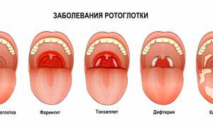 Виды ангин их группировка и классификация