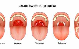 Виды ангин их группировка и классификация