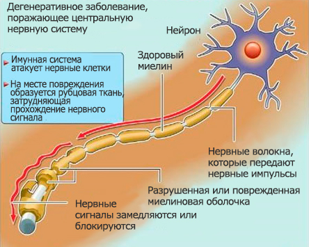 патогенез рассеянного склероза