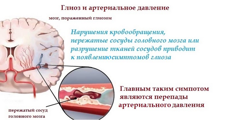 глиоз