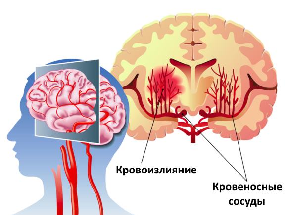 кровоизлияния в головной мозг