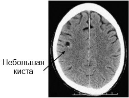 псевдокиста головного мозга у новорожденного на рентгене
