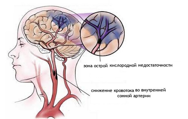 закупорка капилляров головного мозга