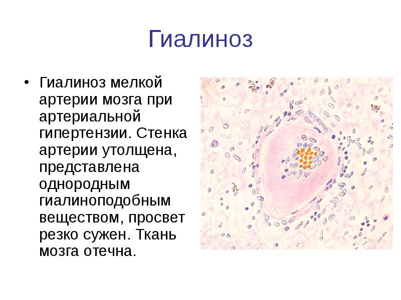 гиалиноз
