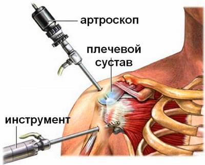 Артроскопия