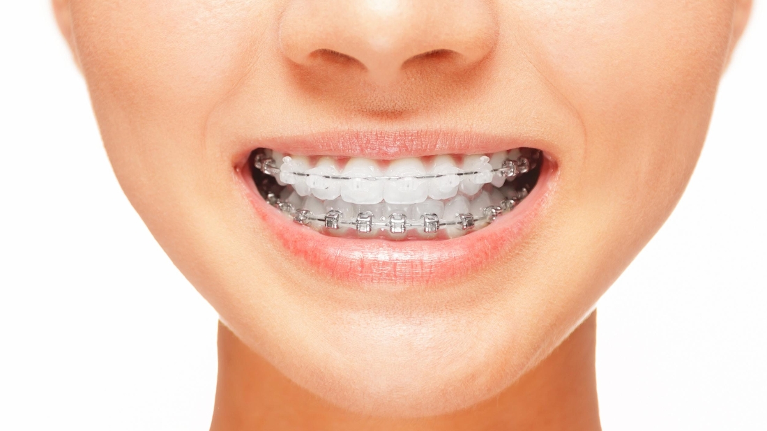 Брекеты улыбка