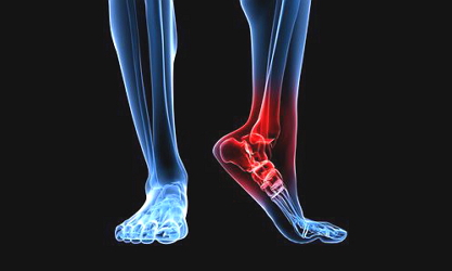 Бурсит голеностопного сустава: лечение, этиология Бурсит