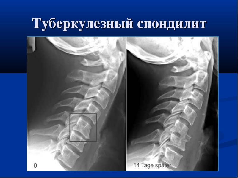 Туберкулез позвоночника