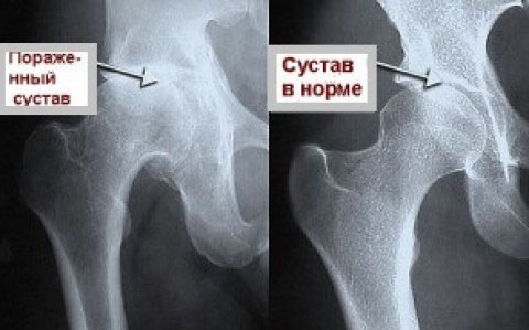 Туберкулез тазобедренного сустава