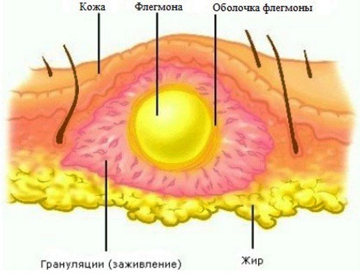 Инфекционные осложнения артрита - флегмоны