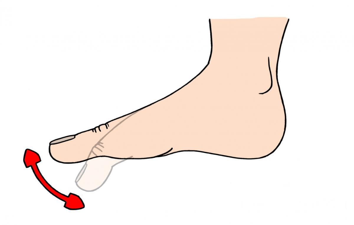 Искривление пальцев стопы