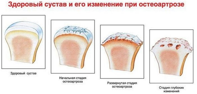 изменения в коленном суставе при остеоартрозе