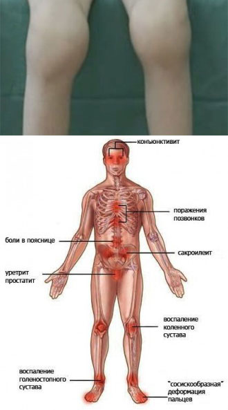критерии диагностики реактивного артрита у детей