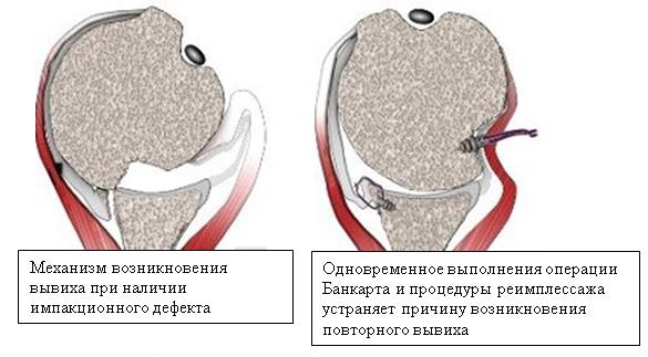Операция Банкарта