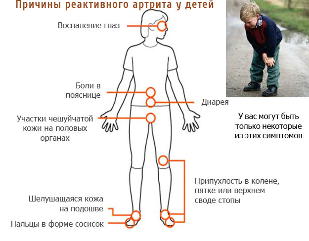 Причины реактивного артрита у детей