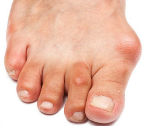 Бурсит голеностопного сустава: лечение, этиология Бурсит пальцев стопы