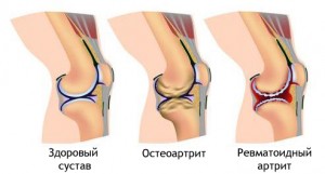 Признаки ревматоидного артрита