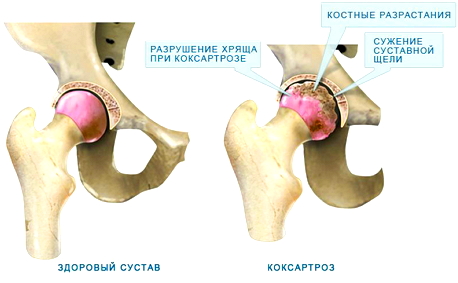 признаки коксартроза тазобедренного сустава