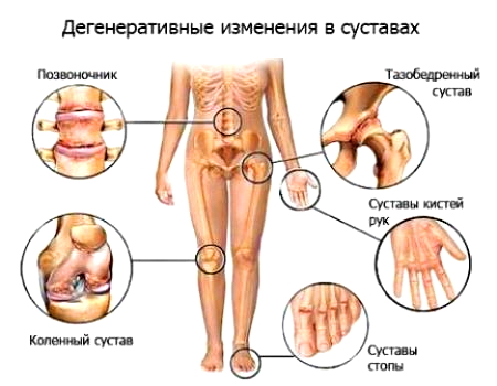 полиартроз - дегенеративные изменения в суставах