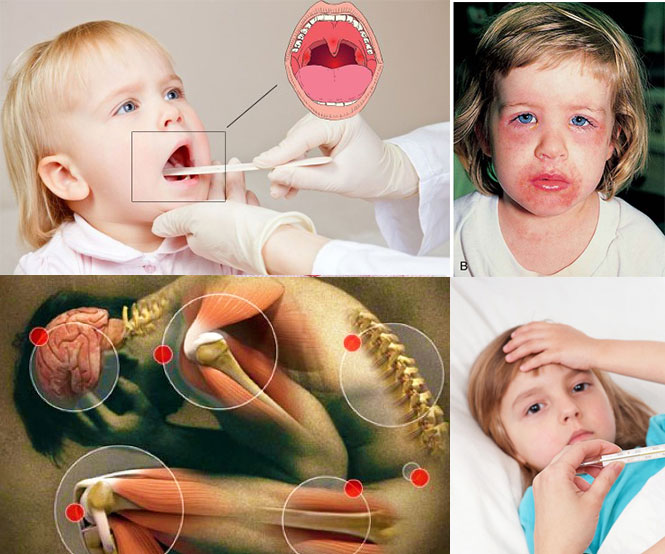 Признаки ревматического артрита у детей