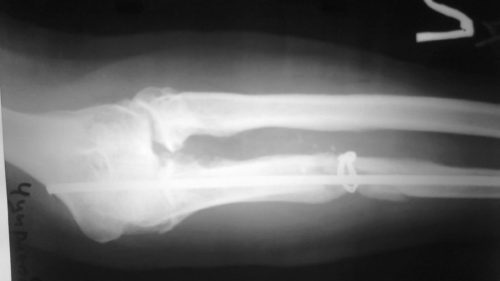 Ложный сустав - псевдоартроз Ложный сустав