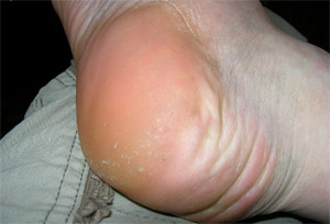 Бурсит голеностопного сустава: лечение, этиология Пяточный бурсит