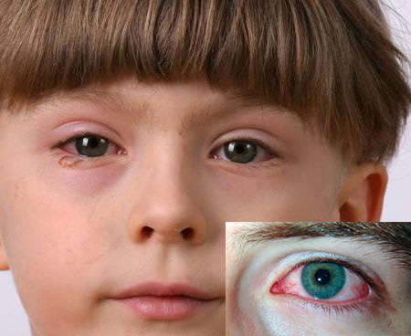 Реактивный артрит у детей