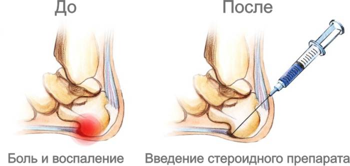 Плантарный фасциит