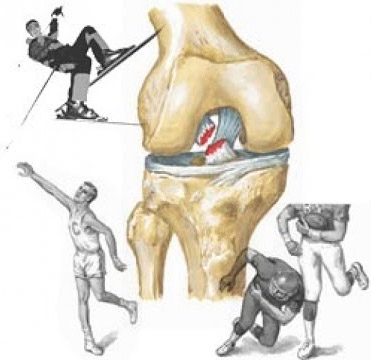 Сильный удар по колену