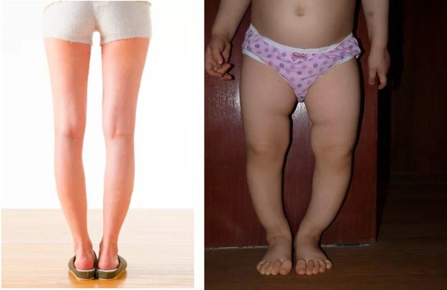 Варусная деформация